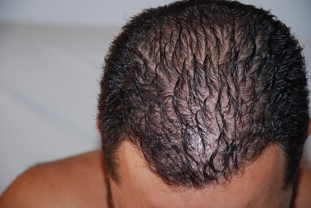 Kit Alpecin Anticaída (Shampoo + Tónico) Unisex - Caída del Cabello / Alopecia
