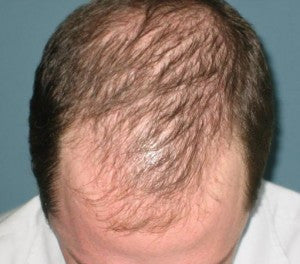 Tónico Alpecin Liquid 200ml Unisex - Caída del Cabello / Alopecia