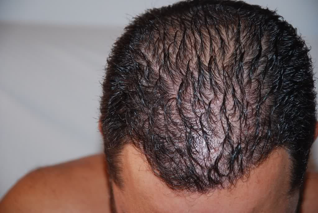 Shampoo Alpecin Caffeine C1 Triple Pack - Caída del Cabello / Alopecia